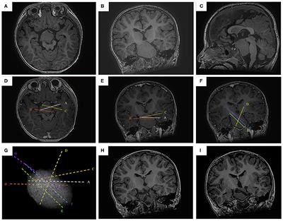 One-Stage High-Density Focal Stereo-Array SEEG-Guided Radiofrequency Thermocoagulation for the Treatment of Pediatric Giant Hypothalamic Hamartomas